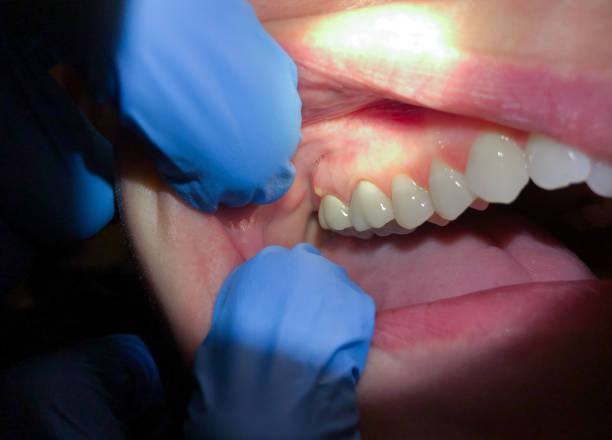 Best Emergency Treatment for Dental Infections or Abscesses in Leadville North, CO